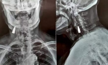 A man living a healthy life despite having a bullet stuck in his neck for 7 decades