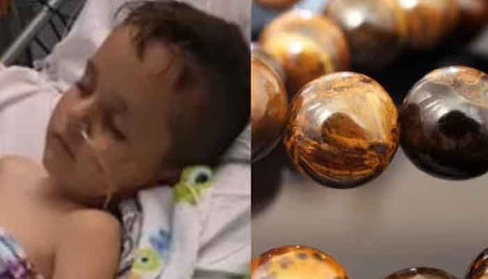 A 5-year-old boy swallowed 52 magnetic balls