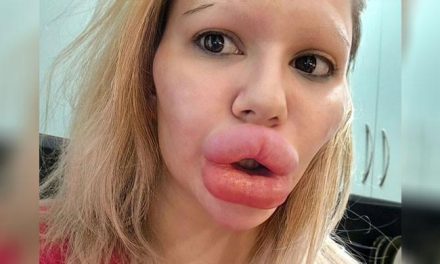 ‘I want bigger lips’: Bulgarian woman’s obsession